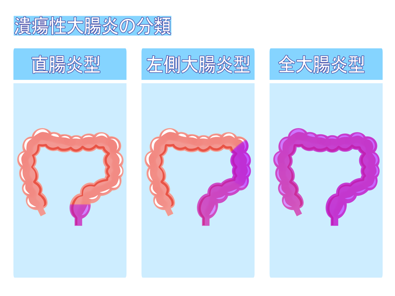 潰瘍性大腸炎とは