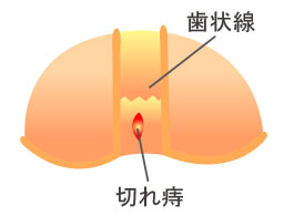 と キュー っ 痛い が おしり おしりが痛くてつらい 病気かも？｜方南町